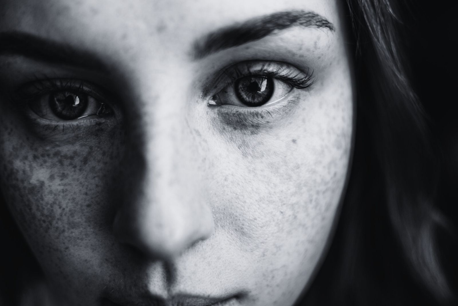 Piel con tendencia acneica y desequilibrio sebáceo en Zaragoza