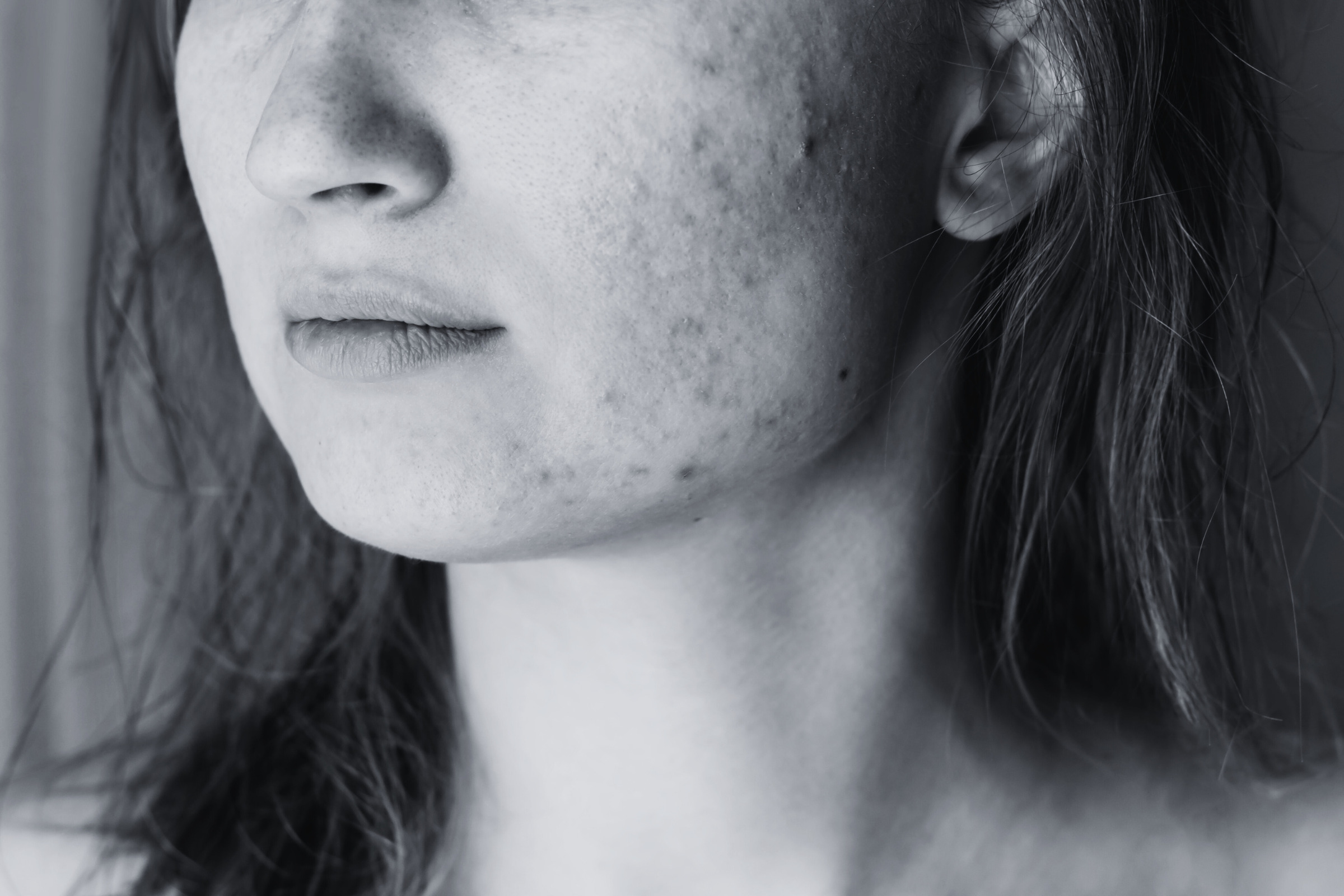 Enfoque profesional para regular piel con tendencia acneica en Zaragoza